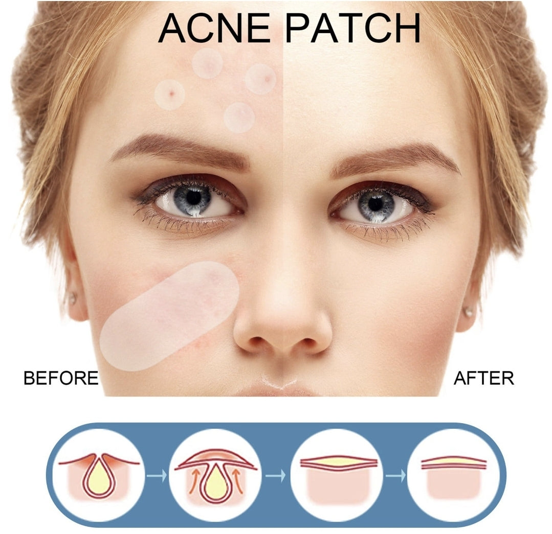 El Secreto Invisible: Parches Anti-Acné de Curación Rápida que Nadie Notará