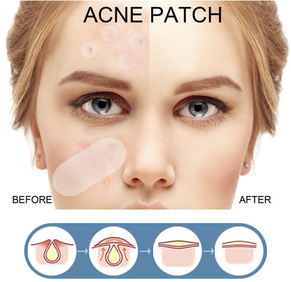 El Secreto Invisible: Parches Anti-Acné de Curación Rápida que Nadie Notará