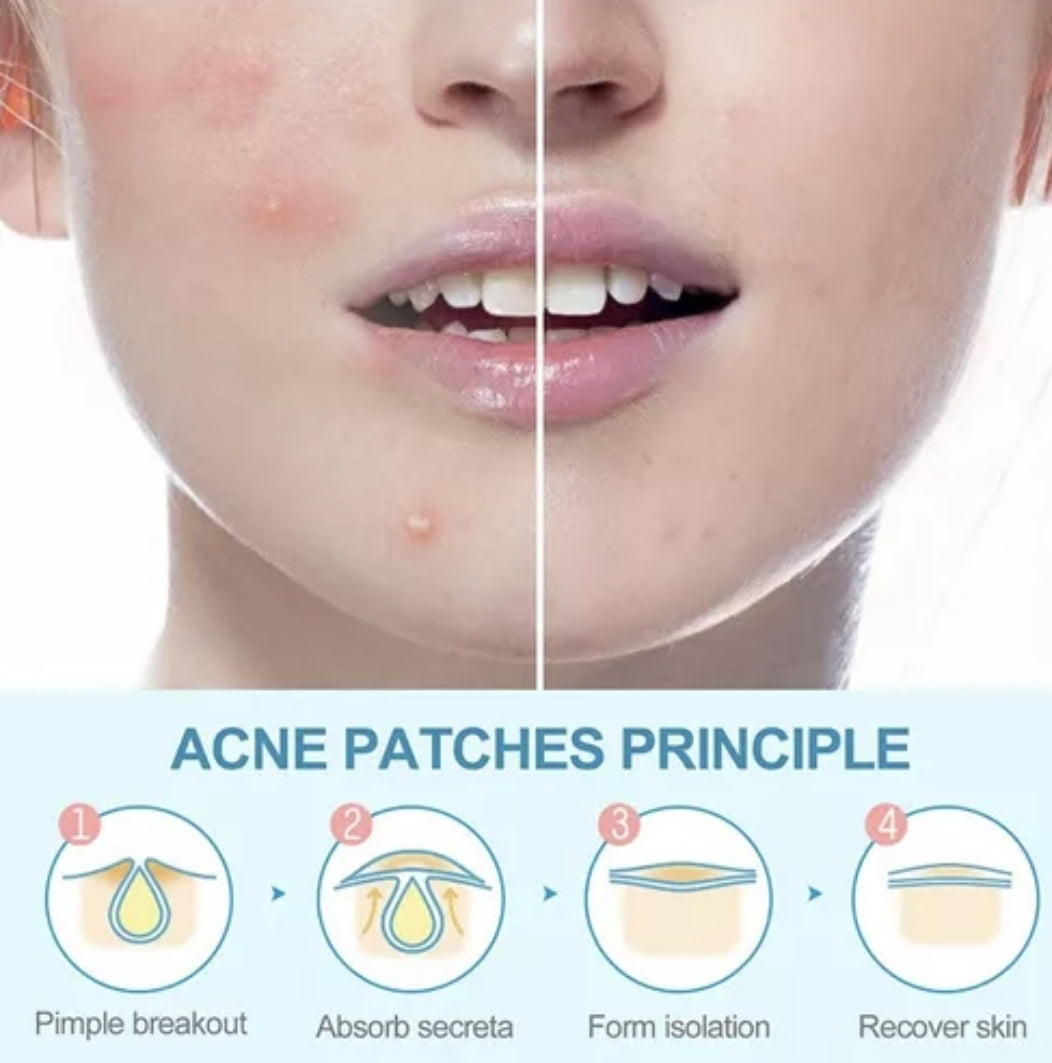 El Secreto Invisible: Parches Anti-Acné de Curación Rápida que Nadie Notará
